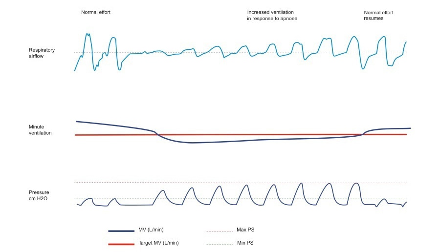 minut-ventilation-aircurve10cs-pacewave-resmed